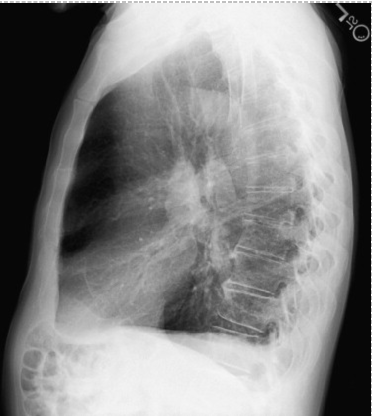 <p>On a lateral view CXR positive for COPD what are some red flags?</p>