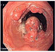 <p><strong>Esophageal Cancer: Adenocarcinoma</strong></p><p>-Epidemiology → men > women, Caucasian </p><p>-Risk Factors → ____/Barrett’s metaplasia, tobacco, obesity </p><p>-Pathogenesis → located near the ___ and associated with _______’_ esophagus. May present as _____, nodule, altered mucosal pattern. Lymph nodes involved _____</p>