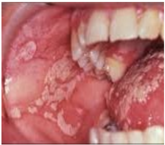 <p>What lesion is this?</p>