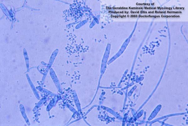 <p>What is the parasite shown in the image?</p><p>Utilize the following characteristics:</p><p><span>•Macroconidia have NO terminal appendages.</span></p><p><span>•Thin – walled macroconidia usually have fewer than 6 cells commonly.&nbsp;</span></p><p><span>•Grows on DTM within 5 to 7 days</span></p>