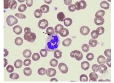<p><span style="font-family: Helvetica; font-size: 12px;">Which of the following is FALSE regarding the small projection indicated on this neutrophil?</span></p><p><span style="font-family: Helvetica; font-size: 12px;">a. It is a Barr body</span></p><p><span style="font-family: Helvetica; font-size: 12px;">b. It is a normal finding in patients with an inactive X chromosome</span></p><p><span style="font-family: Helvetica; font-size: 12px;">c. It is found only in disease states</span></p><p><span style="font-family: Helvetica; font-size: 12px;">d. It is typically seen in 2-3% of neutrophils when present</span></p><p></p>
