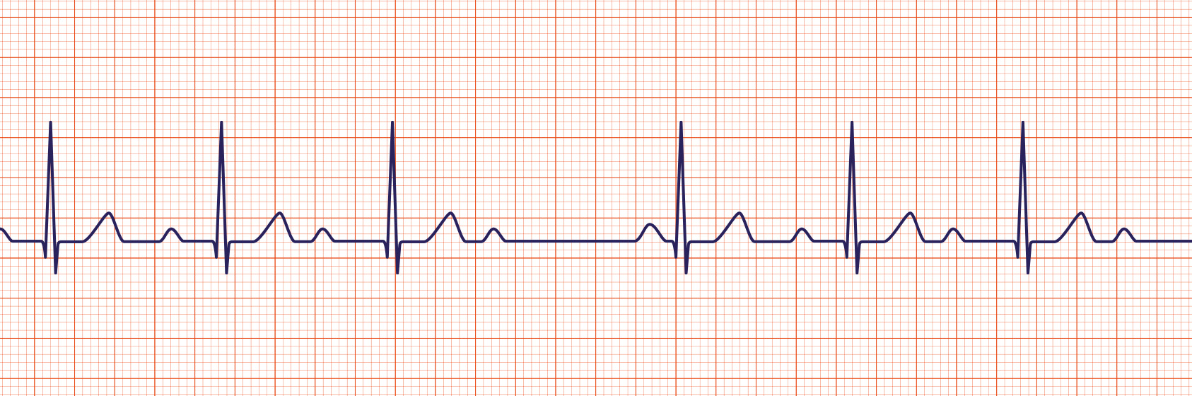 <p><span>A 2</span><sup>nd</sup><span> degree AV block is usually classified as Mobitz Type I (Wenckebach) or Mobitz Type II. A Mobitz Type I heart block is characterized by progressive lengthening of the PR interval until a QRS complex is dropped.</span></p>