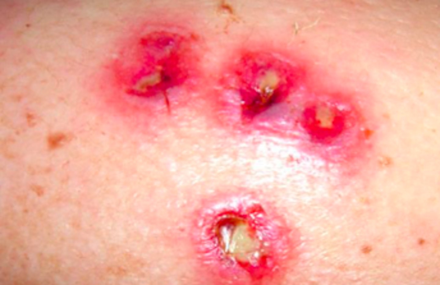 <p>Bacterial Skin Infections:</p><p>deeper impetigo (down to dermis (takes weeks to occur)</p>