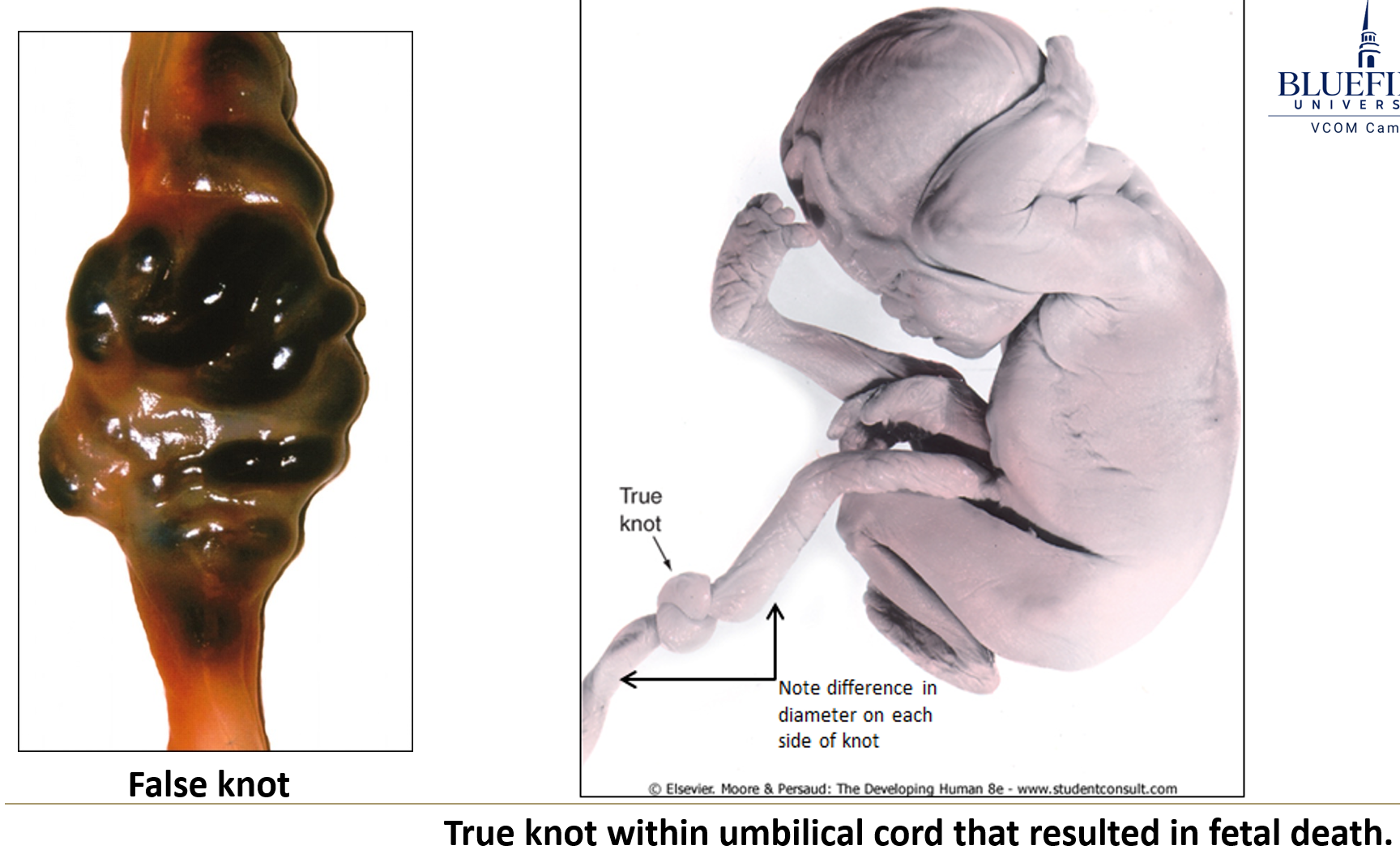 <ul><li><p class="">If <strong>too short</strong>, the cord may <strong>detach the placenta</strong> before birth.</p></li><li><p class="">If <strong>too long</strong>, it may:</p><ul><li><p class="">Form <strong>true knots</strong>, <strong>diminishing circulation</strong></p></li><li><p class=""><strong>Wrap tightly</strong> around limbs, <strong>impairing blood flow</strong> and <strong>development</strong></p></li></ul></li></ul><p></p>