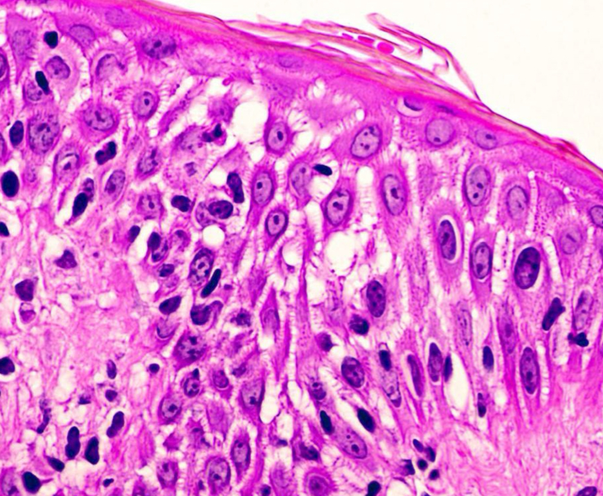 <p>what condition is depicted, describe it</p>