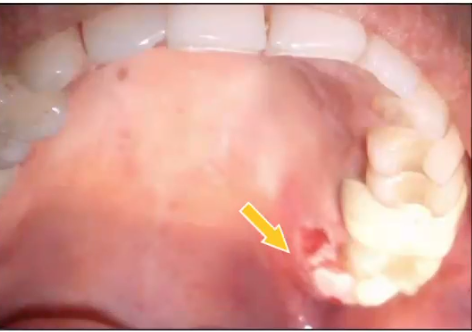 <p>following dental procedure patient developed this ulcer, what is the most likely cause? </p>