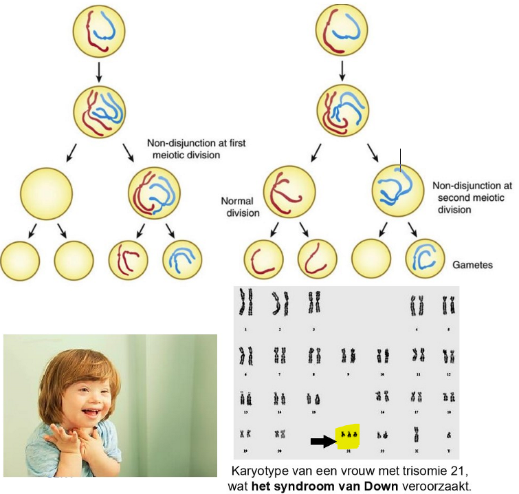 <ul><li><p>non-disjunctie</p><p>= tijdens 1e of 2e rijpingsdeling wijkt een chromosomenpaar niet uiteen</p><ul><li><p>nondisjunctie van homologe chromosomenparen tijdens meiose I</p></li><li><p>nondisjunctie in meiose II ten gevolge van mislukte scheiding van zusterchromatiden</p></li></ul><p>→ rijpe gameet heeft n+1 of n-1 chromosomen</p></li><li><p>algemeen: monosomie van een autosoom is niet levensvatbaar</p><ul><li><p>Down-syndroom: trisomie van chromosoom 21</p></li><li><p>Klinefelter syndroom: 47, XXY (man)</p><ul><li><p>gynecomastie, onderontwikkelde gonaden</p></li></ul></li><li><p>Turner syndroom: 45, X (vrouw)</p></li></ul></li><li><p>tijdens mitose: non-disjunctie kan ook optreden tijdens mitose (celdeling die plaatsvindt na bevruchting in somatische cellen)</p><ul><li><p>kan resulteren in mosaïcisme = sommige cellen van het lichaam hebben dan een ander chromosomenaantal dan andere</p></li></ul></li></ul><p>→ naarmate een vrouw ouder wordt, neemt het risico op niet-disjunctie toe =&gt; vergroot de kans op chromosomale afwijkingen in de nakomeling, bv. Downsyndroom</p><p></p>