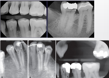 <p>occlusal usually not as well-defined (pic shows B/L caries) </p>