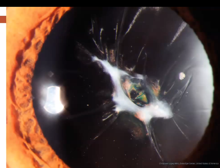<p>sutural cataract </p>