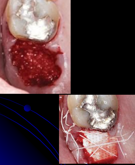 <p>What are the steps for ridge preservation?</p>