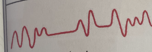 <ul><li><p>Significant <strong>disorganization </strong>with <strong>irregular</strong> and <strong>varying depths</strong> of respiration</p></li><li><p>More <strong>extreme expression of Biot’s respirations</strong> indicating <strong>respiratory compromise</strong></p></li></ul><p></p>