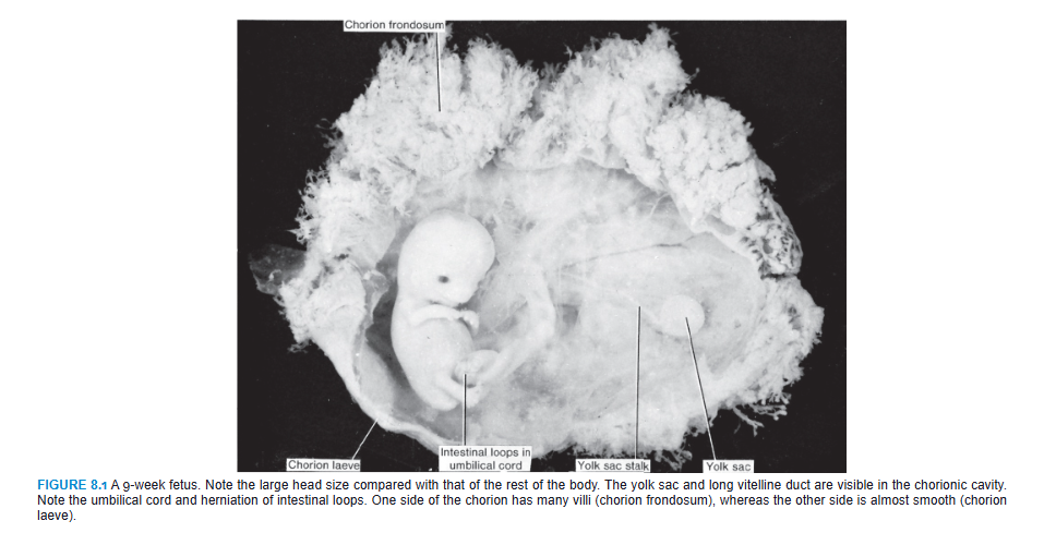 <p>Monthly Changes</p><p>One of the most striking changes taking place during fetal life is the relative slowdown in growth of the head compared with the rest of the body. At the beginning of the third month, the head constitutes approximately half of the CRL (Figs. 8.1 and 8.2). By the beginning of the fifth month, the size of the head is about one-third of the CHL, and at birth, it is approximately one-quarter of the CHL (Fig. 8.2). Hence, over time, growth of the body accelerates but that of the head slows down.</p><p>During the third month, the face becomes more human looking (Figs. 8.3 and 8.4). The eyes, initially directed laterally, move to the ventral aspect of the face, and the ears come to lie close to their definitive position at the side of the head (Fig. 8.3). The limbs reach their relative length in comparison with the rest of the body, although the lower limbs are still a little shorter and less well developed than the upper extremities. Primary ossification centers are present in the long bones and skull by the 12th week. Also, by the 12th week, external genitalia develop to such a degree that the sex of the fetus can be determined by external examination (ultrasound). During the 6th week, intestinal loops cause a large swelling (herniation) in the umbilical cord, but by the 12th week, the loops have withdrawn into the abdominal cavity. At the end of the third month, reflex activity can be evoked in aborted fetuses, indicating muscular activity.</p><p>During the fourth and fifth months, the fetus lengthens rapidly (Fig. 8.5 and Table 8.1), and at the end of the first half of intrauterine life, its CRL is approximately 15 cm, about half the total length of the newborn. The weight of the fetus increases little during this period and by the end of the fifth month is still <500 g. The fetus is covered with fine hair, called lanugo hair; eyebrows and head hair are also visible. During the fifth month, the mother can feel movements of the fetus.</p>