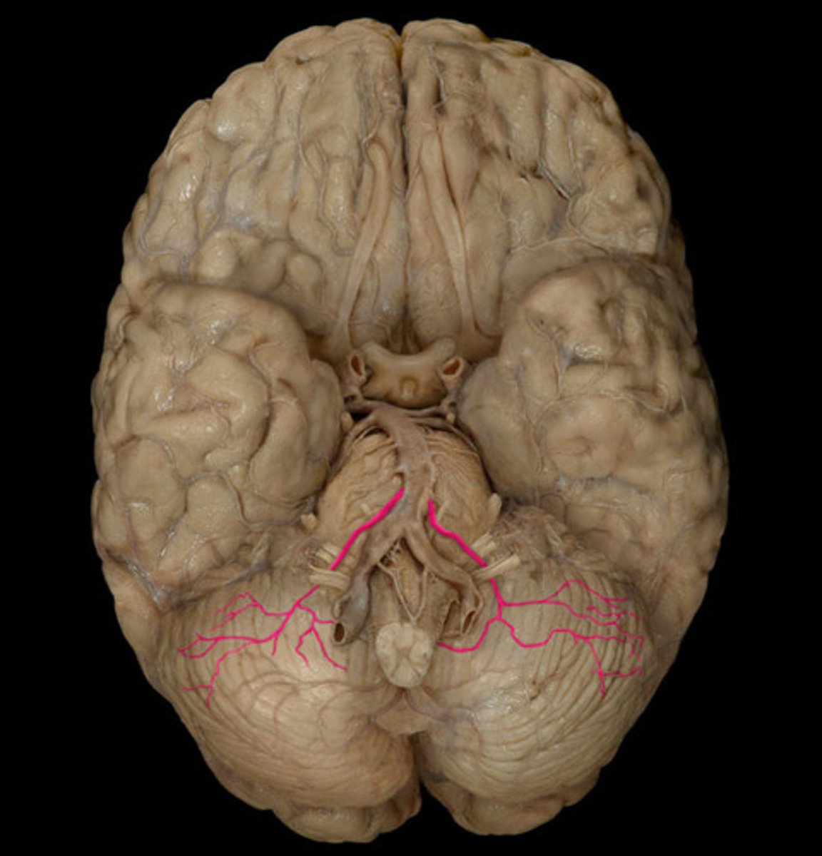 <p>anterior inferior cerebellar artery</p>