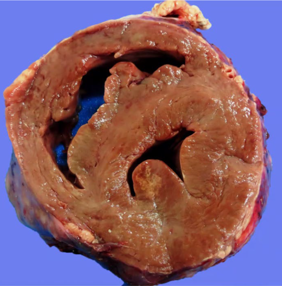 <p>What is another organ affected?</p><p>A-Kidneys</p><p>B-Adrenal gland</p><p>C-Lungs</p><p>D-Uterus</p>