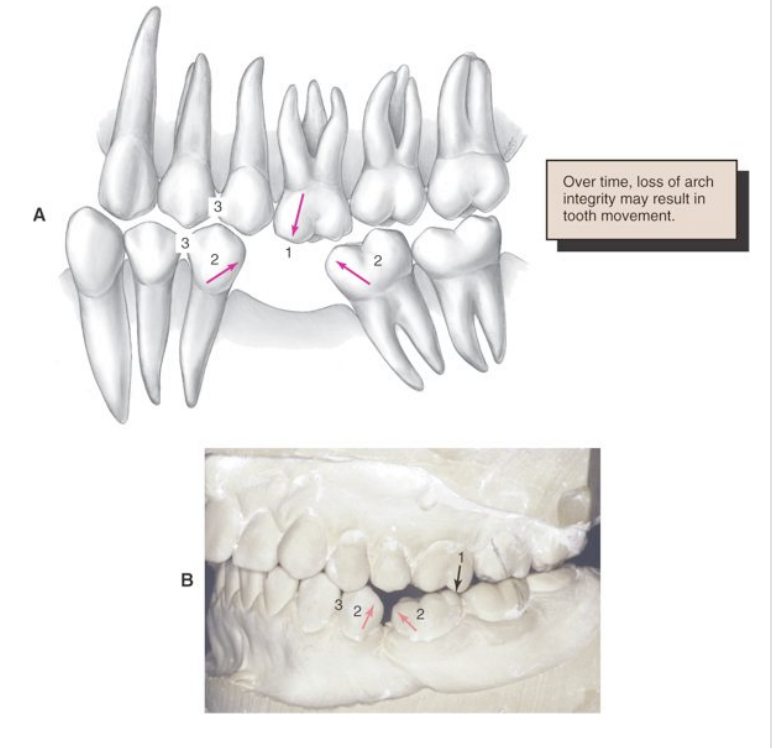<ul><li><p>adjacent teeth may drift/tilt mesially/distally </p></li><li><p>the opposing tooth may retrude into the edentulous space </p></li><li><p>premature contacts may be created during protrusive movement </p></li></ul><p></p>