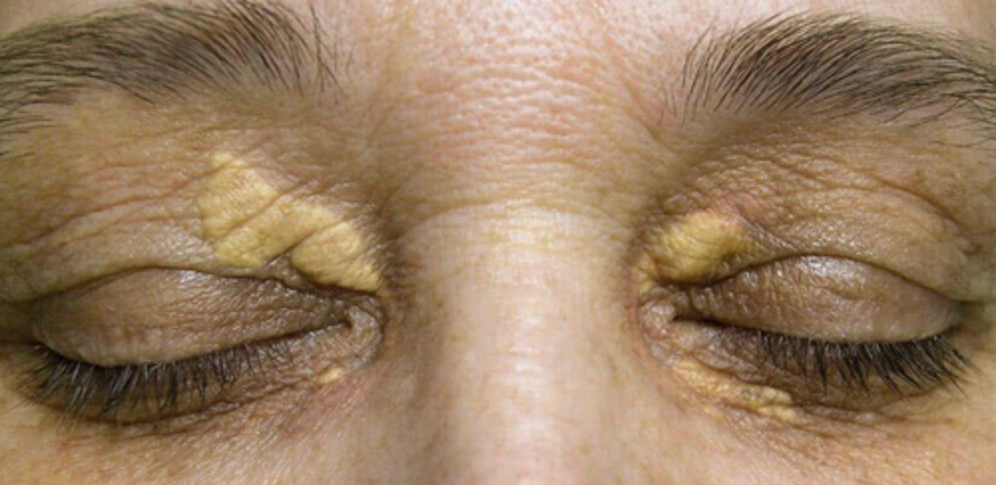 <p>> age 50 = no tx needed</p><p>< age 50 = refer for hyperlipidemia testing</p>