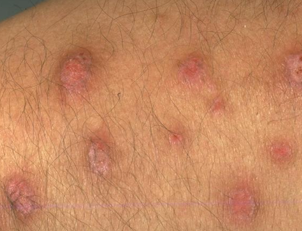 <p>Purple, pruritic, polygonal papules (4Ps)</p>