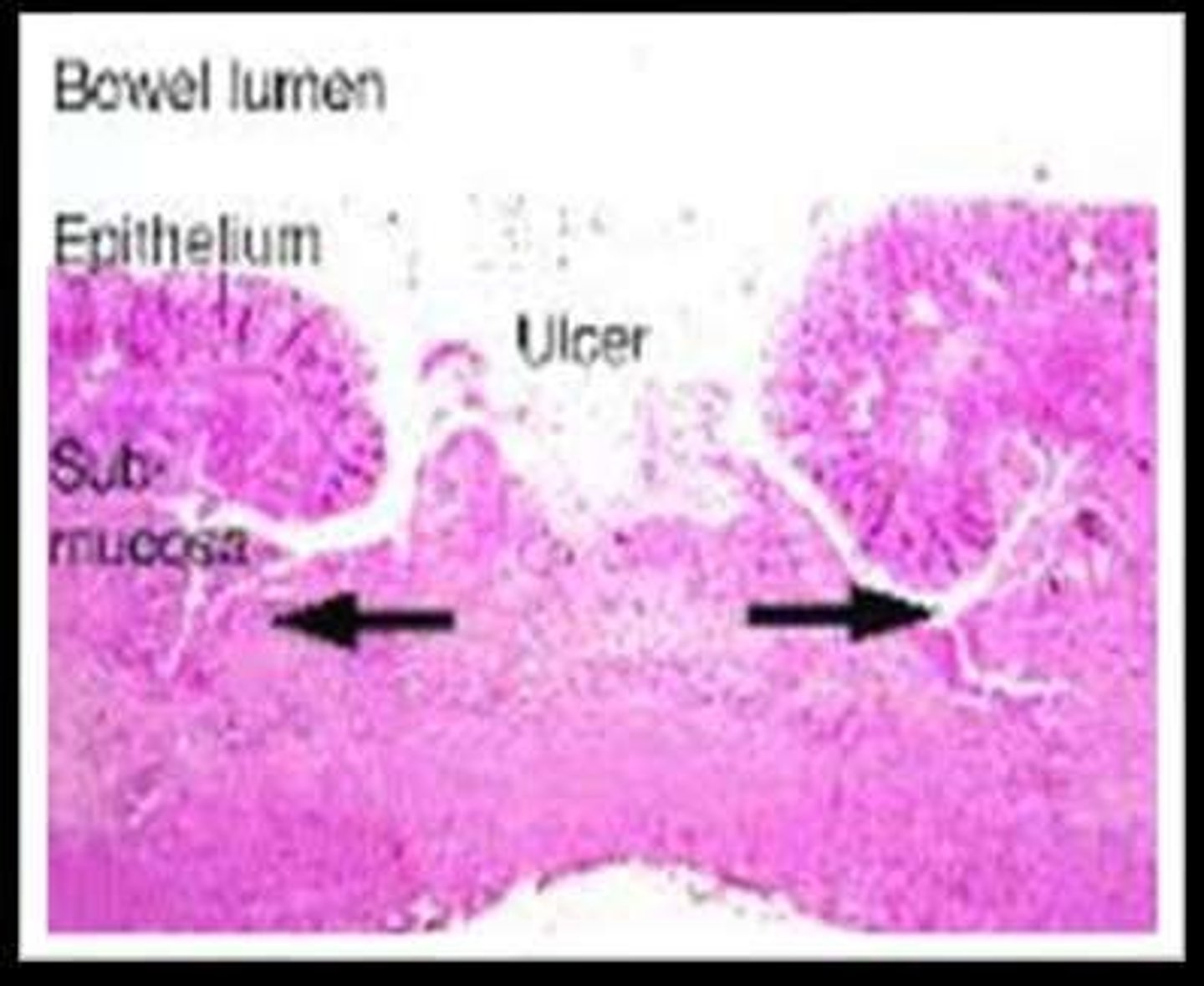 <p>Severe intestinal infection caused by E. histolytica.</p>