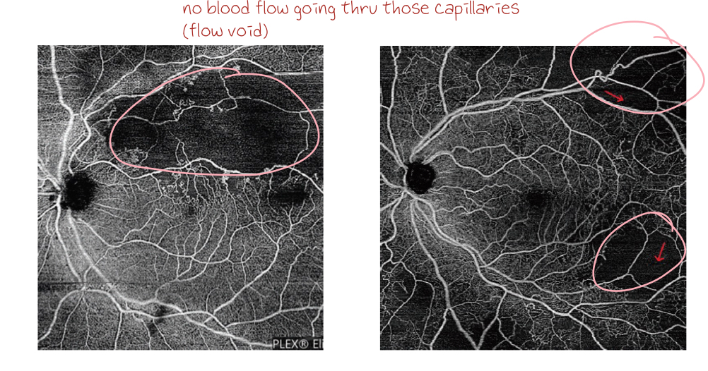 <p>best seen on OCT-A</p><ul><li><p>areas of flow void in deep vascular complex slab</p></li></ul><p></p>