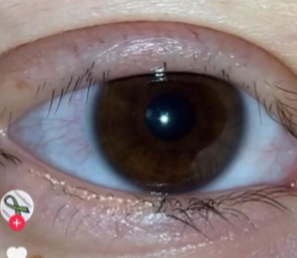 <p>What eyelash condition is this?</p>