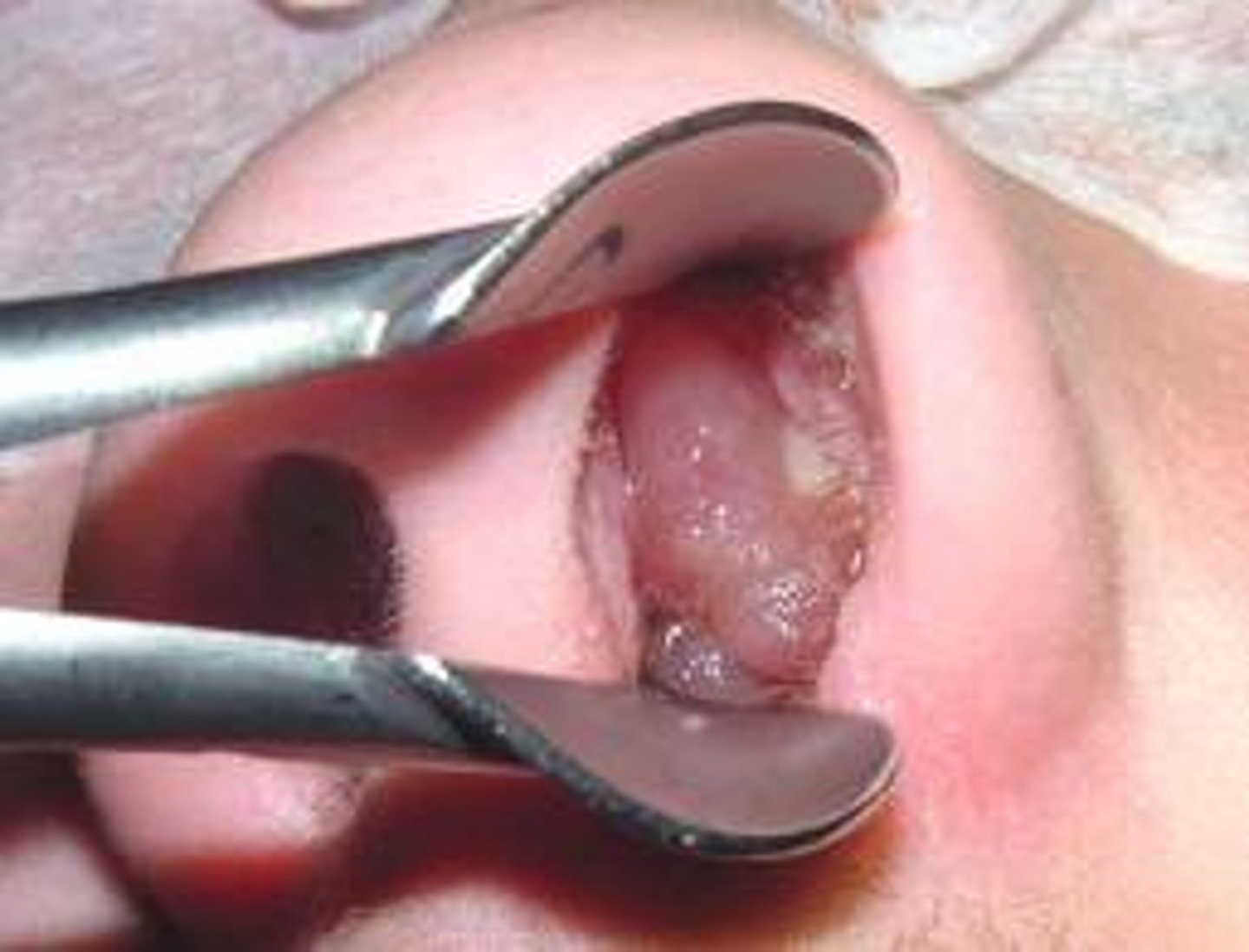 <p>Benign tumors found on the nasal turbinates, originating in the maxillary and ethmoid sinuses</p>