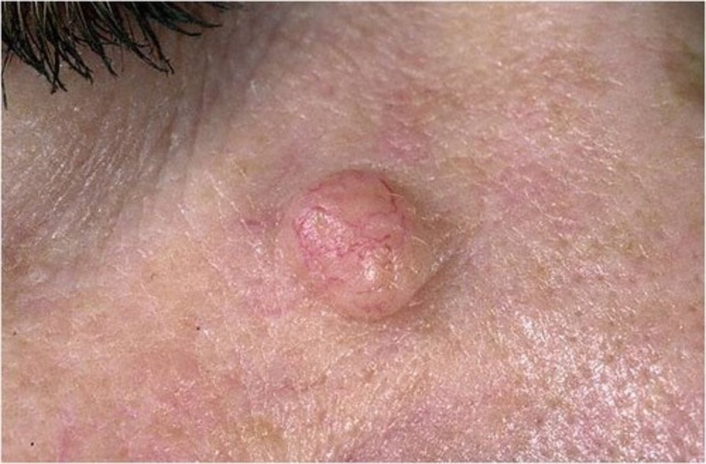 <p>Solid, elevated, hard or soft, larger than 1 cm. May extend deeper into dermis than papule. Examples: xanthoma, fibroma, intradermal nevi.</p>