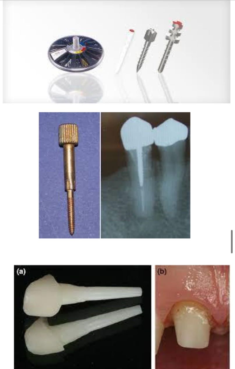 <p><strong>Direct</strong>- ready made in diff sizes, shapes and compositions</p><p><strong>Indirect</strong>- made in lab using impression of root canal</p><p><strong>Semi direct</strong>- mix impression of root canal and <strong>prefabricated fiber post and composite</strong></p>