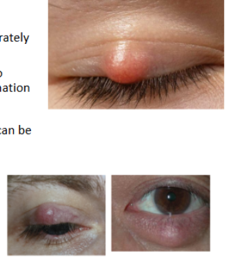 <p>chalazion</p>
