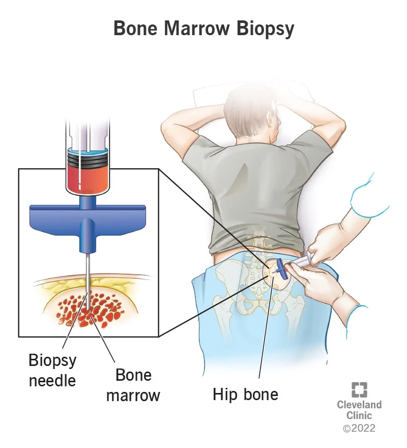 <p>A small amount of bone marrow is removed and the blood elements and their precursors are evaluated</p><p>Also used for checking for the presence of abnormal or malignant cells</p>