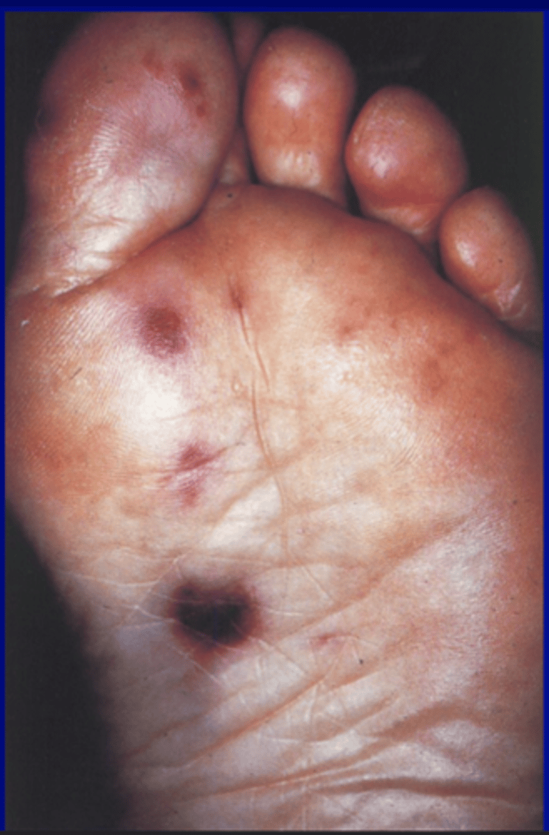 <p>painless flat blanching discolorations on palms and soles</p>