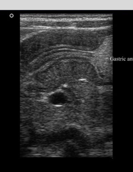 <p>Describe the 'string sign' and its common clinical associations.</p>