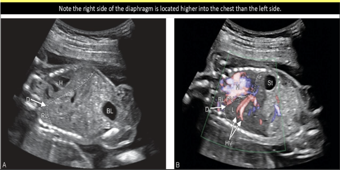 <p>which fetal abn <strong>mimics</strong> the sono appearance of <strong>diaphragmatic hernia</strong></p><p>.</p><p>a) situs inversus</p><p>b) situs solitus</p><p>c) duodenal atresia</p><p>d) [diaphragmatic] eventration</p>