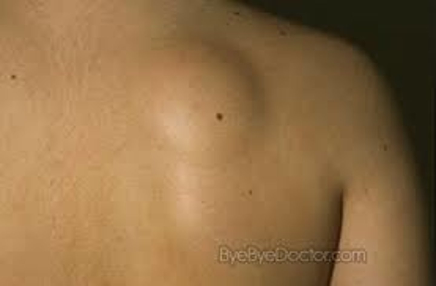 <p>Subcutaneous collection of fat </p><p>Soft, SQ nodule w/o overlying skin changes </p><p>Common on trunk and proximal extremities </p>