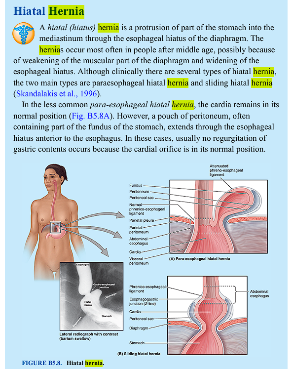 <p>"Hiatal" is <strong><mark data-color="unset" style="background-color: unset; color: inherit;">an adjective referring to a hiatus, which is an opening, specifically in the diaphragm, through which the esophagus passes to connect to the stomach. </mark></strong></p><ul><li><p class="ds-markdown-paragraph"><strong>Hiatal:</strong> From the Latin <strong><em>hiatus</em></strong>, meaning <strong>"an opening, gap, or cleft."</strong></p></li><li><p class="ds-markdown-paragraph"><strong>Hernia:</strong> From the Greek <strong><em>hernos</em></strong> (ἕρνος), meaning <strong>"a bud or sprout."</strong></p></li></ul><p class="ds-markdown-paragraph">So, a <strong>hiatal hernia</strong> is fundamentally a <strong>"budding through an opening"</strong>—specifically, the opening in the diaphragm called the <strong>esophageal hiatus</strong>, through which the esophagus passes to connect to the stomach.</p><p><u>1. Sliding Hiatal Hernia (Type I)</u></p><p>This is by far the <strong>most common type</strong>, accounting for over 95% of all hiatal hernias.</p><ul><li><p class="ds-markdown-paragraph"><strong>Mechanism:</strong> The <strong>gastroesophageal junction (GEJ)</strong>—the point where the <span style="color: blue;">esophagus</span> meets the stomach—is pulled <strong>upward</strong>, or "<span style="color: blue;">slides," through the diaphragmatic hiatus into the chest.</span></p></li><li><p class="ds-markdown-paragraph"><strong>Anatomy:</strong> The GEJ is no longer located below the diaphragm but is displaced into the mediastinum. The stomach fundus follows, but the relationship between the esophagus and stomach remains normal.</p></li></ul><p class="ds-markdown-paragraph"><u>2. Paraesophageal Hiatal Hernia (Types II, III, IV)</u></p><p class="ds-markdown-paragraph">This is less common but <strong>more dangerous</strong>. The term "<span style="color: blue;">para</span>esophageal" means "<span style="color: blue;">alongside the esophagus</span>."</p><ul><li><p class="ds-markdown-paragraph"><strong>Mechanism:</strong> The <strong>GEJ remains in its normal position, fixed below the diaphragm</strong>. However, a portion of the stomach, typically the <strong>fundus</strong>, pushes up through the hiatus <em>alongside (para-)</em> the esophagus. In its pure form (Type II), this creates a "rolling" hernia.</p></li><li><p class="ds-markdown-paragraph"><strong>Anatomy:</strong> The GEJ is correctly located, but a pocket of stomach lies in the chest next to the esophagus.</p></li></ul><p></p>