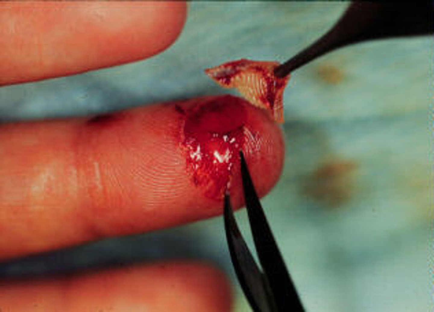 <p>injury in which a portion of the skin and sometimes other soft tissue is partially or completely torn away</p>