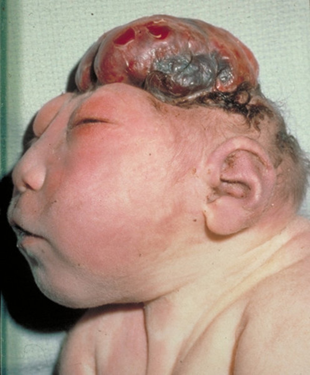 <p>Define Anencephaly</p>
