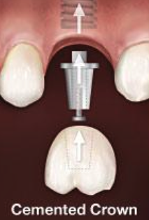<p>What kind of crown is abutment supported?</p>