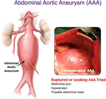 <p>Ruptured or leaking AAA “triad” Aortic Aneurysm</p>
