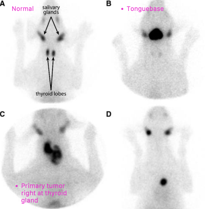 <p>1. routine CBC/chem/UA, 3V-CXR</p><p>2. cervical ultrasound</p><p>3. cytology</p><p>4. CT of neck</p><p>5. scintigraphy</p>