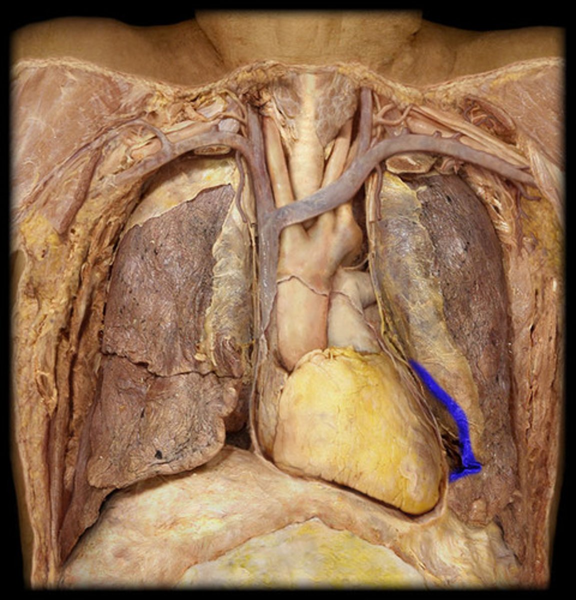<p>looks kinda like a triangular shaped divot or a bite</p><p>on the mediastinal surface </p><ul><li><p>depression</p></li></ul><p></p>