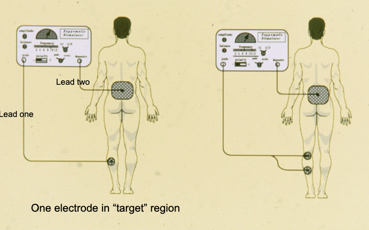 <ul><li><p>one electrode in target area is called a monopolar set up </p></li><li><p>two in the area is a bipolar set up </p></li><li><p>4 in the area is quadripolar </p></li><li><p>more placements = recruitment</p><ul><li><p>use amplitude to increase </p></li></ul></li></ul><p></p>