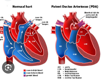 <p>-Cyanose:</p><ul><li><p>Perifere cyanose → o.a bij verminderde cardiac output door ondervulling of bij lokale afkoeling van extremiteiten.</p></li><li><p>Centrale cyanose → oorzaak ligt cardiaal of pulmonaal.</p></li><li><p>Rechts-linksshunt met belemmering voor de toevoer van bloed naar de longcirculatie.</p></li><li><p>Obligate menging van zuurstofrijk bloed met zuurstofarm bloed.</p></li></ul><p>Hartgeruis (pasgeborenen kunnen onschuldig hartgeruis hebben):</p><ul><li><p>Continue geruis → typisch voor persisterende dusctus arteriosus/ductus botalli.</p></li><li><p>Systolisch geruis (wanneer het hart samentrekt).</p></li><li><p>Diastolisch geruis (wanneer het hart ontspant).</p></li></ul><p>-Decompensatio cordis: situatie waarin het myocard onvoldoende pompcapaciteit heeft en de compensatiemechanismen dit onvoldoende kunnen opvangen. Meestal wordt dit bij kinderen veroorzaakt door obstructief hartlijden.</p><p>-Cyanotic spells (niet hetzelfde als breath-holding spells). Het is eigenlijk een aanval van cyanose.</p>