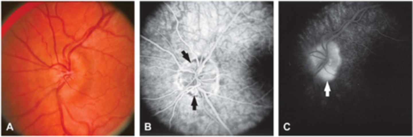 <p>late peripapillary staining (noduler, circumferential)</p>