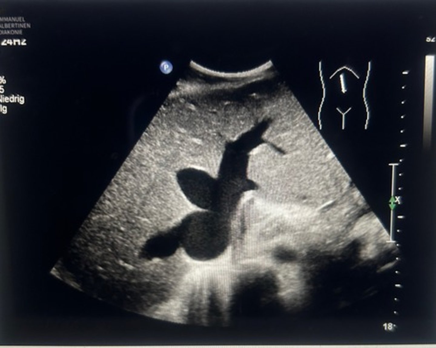<p>Right heart failure</p>