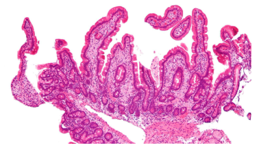 <p>what disease is this the histology of?</p>