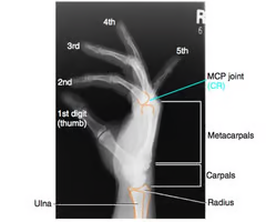 <p><span>-Proper collimation<br>-side markers anteriorly<br>-fingertips too distal ends of the radius and ulna<br>-Extended digits<br>-Hand truly lateral: -superimposed phalanges, metacarpals, and radius and ulna<br>-thumb free of motion and superimposition<br>-bony trabecular detail and surrounding soft tissue</span></p>