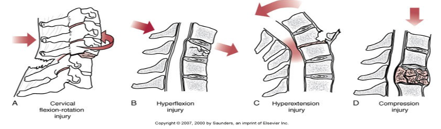 <p>• Flexion and rotation injuries from MVA rear-end accidents </p><p>• Hyperflexion injuries from head on collisions </p><p>• Hyperextension injuries from fall </p><p>• Compression injuries from osteoporosis, degenerative changes, diving injuries, falls from elevated surfaces</p>