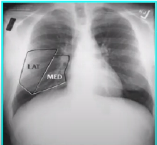 <p><span style="color: green">Como se ve el lóbulo medio (seg 4 y 5) del pulmoncderecho</span></p>