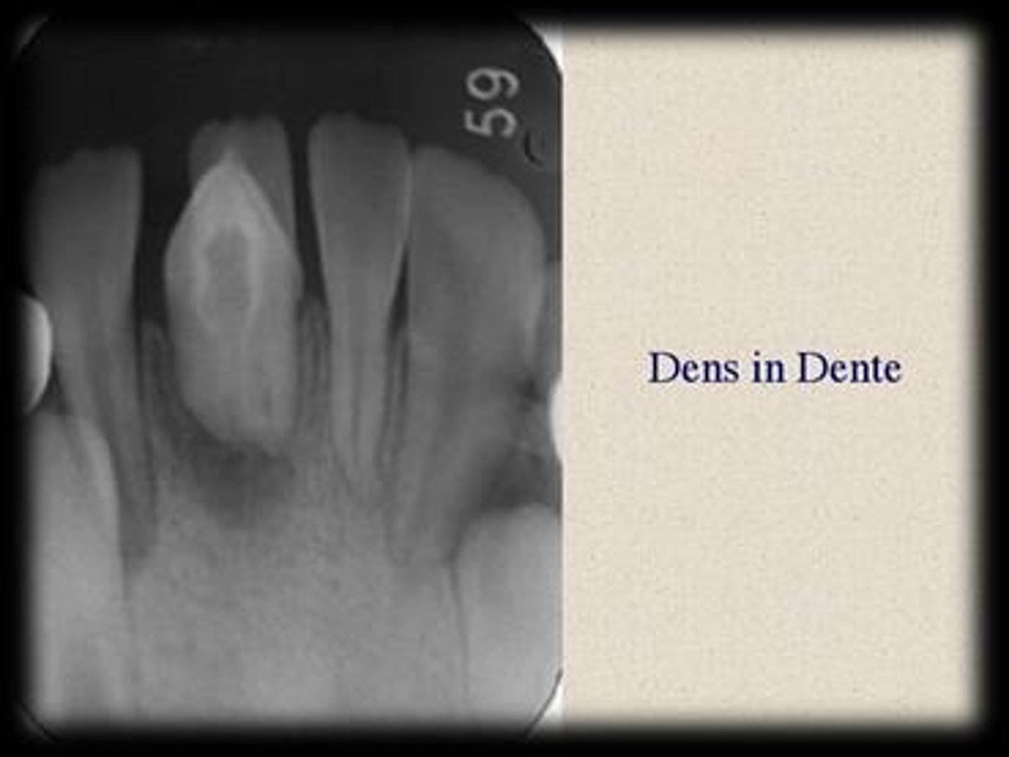 <p>A condition where the enamel organ invaginates into the dental papilla, commonly affecting permanent maxillary lateral incisors.</p>