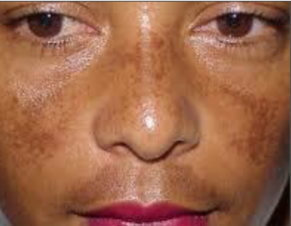 <p>hyperpigmentation of sun exposed skin </p>